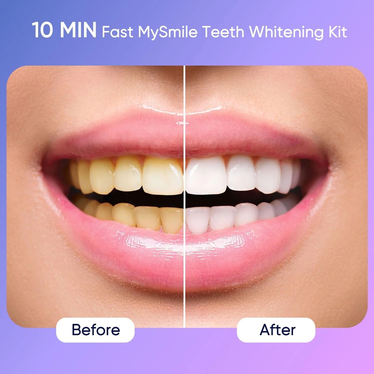 Ultimate Teeth Whitening Kit with 28 LED Light, 4X 3ML 35%CP Teeth Whitening Gel, 1X 4ML Teeth Whitening Pen, 10 Min, Remove 10 Years of Stains